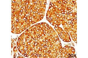 IHC staining of melanoma tissue (20X) with Tyrosinase antibody (T311). (TYR 抗体)