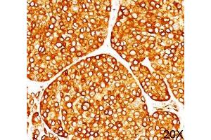 IHC staining of melanoma tissue (20X) with Tyrosinase antibody (T311). (TYR 抗体)