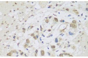 Immunohistochemistry of paraffin-embedded Human gastric cancer using DHX38 Polyclonal Antibody at dilution of 1:150 (40x lens). (DHX38 抗体)