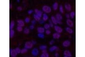 Immunofluorescence analysis of Human lung cancer tissue using Transferrin Monoclonal Antibody at dilution of 1:200.