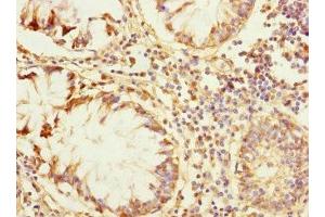 Immunohistochemistry of paraffin-embedded human colon cancer using ABIN7176726 at dilution of 1:100 (ZP2 抗体  (AA 651-745))