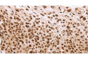 Immunohistochemistry of paraffin-embedded Human esophagus cancer using PARP1 Polyclonal Antibody at dilution of 1:40 (PARP1 抗体)