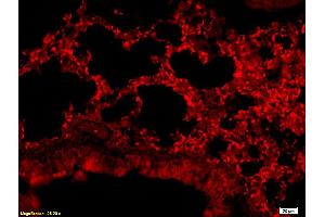 Formalin-fixed and paraffin embedded human colon carcinoma labeled with Anti-CD24 Polyclonal Antibody, Unconjugated (ABIN669681) at 1:200, followed by conjugation to the secondary antibody (CD24 抗体  (AA 60-80))