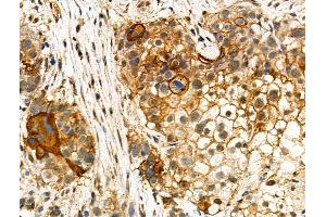 ABIN7093100 and ABIN7097254 at 1/100 staining Human ovarian cancer by IHC-P. (MLKL 抗体  (pSer347))