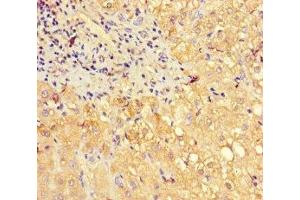 Immunohistochemistry of paraffin-embedded human liver cancer using ABIN7160703 at dilution of 1:100 (PGLYRP2 抗体  (AA 22-576))
