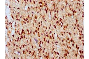 IHC image of ABIN7145109 diluted at 1:700 and staining in paraffin-embedded human glioma performed on a Leica BondTM system. (ATG16L2 抗体  (AA 262-348))