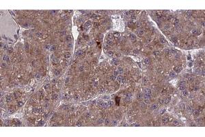 ABIN6273976 at 1/100 staining Human liver cancer tissue by IHC-P. (OR2A2 抗体  (Internal Region))