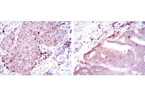 Immunohistochemical analysis of paraffin-embedded kidney cancer tissues (left) and stomach cancer tissues (right) using BMPR2 mouse mAb with DAB staining. (BMPR2 抗体)