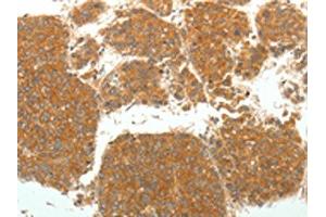 The image on the left is immunohistochemistry of paraffin-embedded Human liver cancer tissue using ABIN7131067(SIRT4 Antibody) at dilution 1/25.