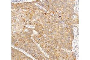 Immunohistochemistry analysis of paraffin-embedded humanes ophagus cancer using INSR (ABIN7074298) at dilution of 1: 6000 (ISR-alpha 抗体)