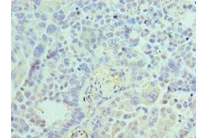 Immunohistochemistry of paraffin-embedded human lung cancer using ABIN7143847 at dilution of 1:100 (ACTR1A 抗体  (AA 187-376))