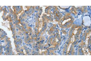 Immunohistochemistry of paraffin-embedded Human thyroid cancer tissue using MUC15 Polyclonal Antibody at dilution 1:50 (MUC15 抗体)