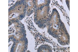 Immunohistochemistry of Human thyroid cancer using GJC2 Polyclonal Antibody at dilution of 1:40 (GJC2 抗体)