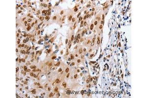 Immunohistochemistry of Human cervical cancer using MUTYH Polyclonal Antibody at dilution of 1:25 (MUTYH 抗体)