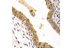 Immunohistochemistry of paraffin-embedded human uterine cancer using CXCR3 Antibody (ABIN5971514) at dilution of 1/200 (40x lens). (CXCR3 抗体)