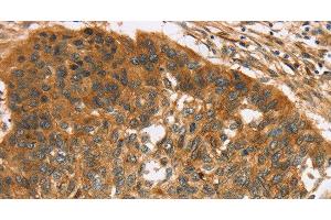Immunohistochemistry of paraffin-embedded Human esophagus cancer using TNFSF15 Polyclonal Antibody at dilution of 1:40 (TNFSF15 抗体)