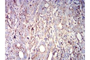 Immunohistochemical analysis of paraffin-embedded cervical cancer tissues using CD63 mouse mAb with DAB staining.