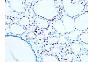 Immunohistochemistry of paraffin-embedded human thyroid cancer using Histone H1. (Histone H1 抗体)