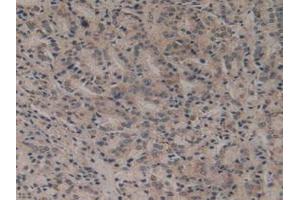 Detection of Flt3 in Human Prostate Gland Cancer Tissue using Polyclonal Antibody to FMS Like Tyrosine Kinase 3 (Flt3) (FLT3 抗体  (AA 334-543))