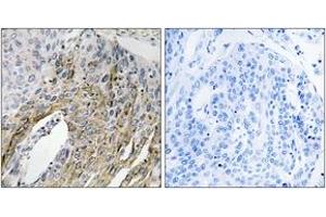 Immunohistochemistry analysis of paraffin-embedded human lung carcinoma tissue, using LONP2 Antibody. (LONP2 抗体  (AA 780-829))