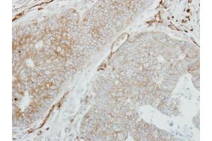 IHC-P Image Immunohistochemical analysis of paraffin-embedded human colon carcinoma, using HLA-DMB, antibody at 1:250 dilution. (HLA-DMB 抗体  (C-Term))