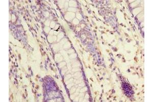 Immunohistochemistry of paraffin-embedded human colon cancer using ABIN7162093 at dilution of 1:100 (FAM55A 抗体  (AA 1-405))