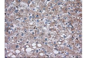Immunohistochemical staining of paraffin-embedded Carcinoma of Human prostate tissue using anti-TBXAS1 mouse monoclonal antibody. (TBXAS1 抗体)