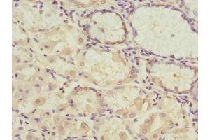 Immunohistochemistry of paraffin-embedded human gastric cancer using ABIN7166902 at dilution of 1:100 (PDHB 抗体  (AA 1-300))