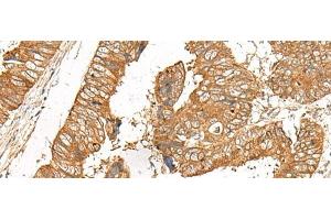 Immunohistochemistry of paraffin-embedded Human colorectal cancer tissue using GOLGA6A Polyclonal Antibody at dilution of 1:50(x200) (GOLGA6A 抗体)