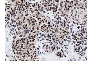 Immunohistochemical staining of paraffin-embedded Carcinoma of Human lung tissue using anti-NT5DC1 mouse monoclonal antibody. (NT5DC1 抗体)