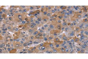 Immunohistochemistry of paraffin-embedded Human liver cancer using NCF2 Polyclonal Antibody at dilution of 1:60 (NCF2 抗体)