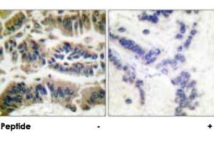 Immunohistochemical analysis of paraffin-embedded human breast carcinoma tissue using CASP6 polyclonal antibody .
