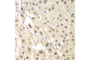 Immunohistochemistry of paraffin-embedded human liver cancer using ETS1 antibody (ABIN5970774) at dilution of 1/100 (40x lens). (ETS1 抗体)