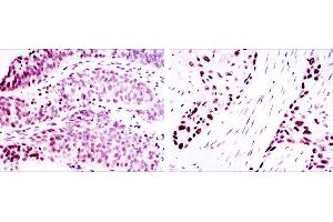 Immunohistochemical analysis of paraffin-embedded ovarian cancer (left) and lung cancer (right) using p63α mouse mAb with DAB staining.
