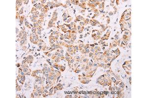 Immunohistochemistry of Human colon cancer using ADAMTS16 Polyclonal Antibody at dilution of 1:50