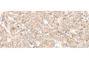 Immunohistochemistry of paraffin-embedded Human ovarian cancer tissue using FAM111B Polyclonal Antibody at dilution of 1:25(x200) (FAM111B 抗体)