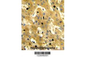Formalin-fixed and paraffin-embedded human hepatocarcinoma reacted with SCP2 Antibody (Center), which was peroxidase-conjugated to the secondary antibody, followed by DAB staining. (SCP2 抗体  (Middle Region))
