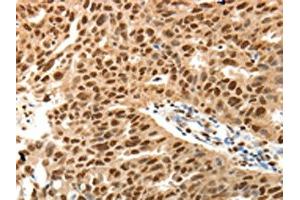 The image on the left is immunohistochemistry of paraffin-embedded Human ovarian cancer tissue using ABIN7131160(SPATA2L Antibody) at dilution 1/30, on the right is treated with fusion protein. (SPATA2L 抗体)