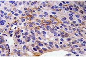Immunohistochemistry (IHC) analyzes of SEMA3A antibody in paraffin-embedded human lung carcinoma tissue. (SEMA3A 抗体)
