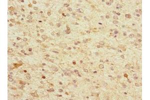 Immunohistochemistry of paraffin-embedded human glioma using ABIN7173721 at dilution of 1:100 (Tppp 抗体  (AA 1-219))
