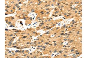 The image on the left is immunohistochemistry of paraffin-embedded Human liver cancer tissue using ABIN7131243(STX8 Antibody) at dilution 1/35, on the right is treated with fusion protein. (STX8 抗体)