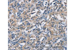 Immunohistochemistry of Human thyroid cancer using APOL1 Polyclonal Antibody at dilution of 1:40 (APOL1 抗体)