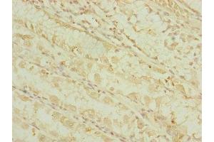 Immunohistochemistry of paraffin-embedded human gastric cancer using ABIN7164317 at dilution of 1:100 (DHTKD1 抗体  (AA 1-280))