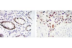 Immunohistochemical analysis of paraffin-embedded colon cancer tissues (left) and lung cancer tissues (right) using KLF4 mouse mAb with DAB staining