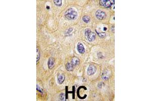 Formalin-fixed and paraffin-embedded human hepatocellular carcinoma reacted with CLDN1 polyclonal antibody  , which was peroxidase-conjugated to the secondary antibody, followed by DAB staining. (Claudin 1 抗体)