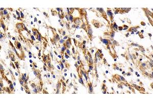 Detection of CYCS in Human Stomach cancer Tissue using Polyclonal Antibody to Cytochrome C (CYCS)