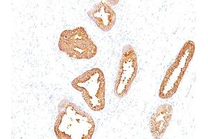 Formalin-fixed, paraffin-embedded human Prostate Carcinoma stained with PSA Mouse Monoclonal Antibody (A67-B/E3). (Prostate Specific Antigen 抗体)