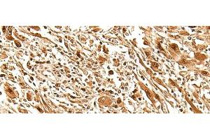 Immunohistochemistry of paraffin-embedded Human liver cancer tissue using FIZ1 Polyclonal Antibody at dilution of 1:35(x200)