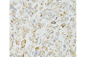 Immunohistochemistry of paraffin-embedded Human lung cancer using DICER1 Polyclonal Antibody at dilution of 1:100 (40x lens). (DICER1 抗体)