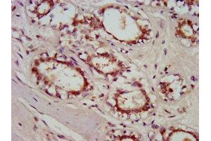IHC image of ABIN7154777 diluted at 1:800 and staining in paraffin-embedded human breast cancer performed on a Leica BondTM system. (GBP4 抗体  (AA 494-603))